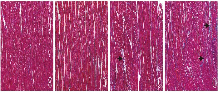 Effect of PD-1 inhibitor on aggravating radiation-induced myocardial injury by catalyzing pyroptosis