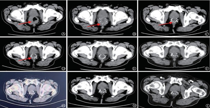 A case of sphincter-preserving treatment for ultra-low rectal cancer using radioactive 125I seed implantation combined with systemic chemotherapy