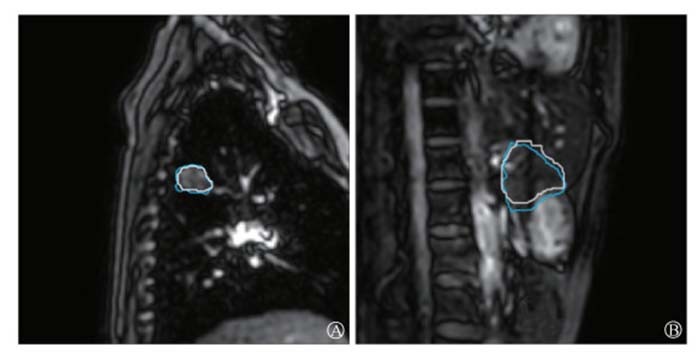 Automatic target volume tracking in magnetic resonance imaging-guided radiotherapy based on artificial intelligence