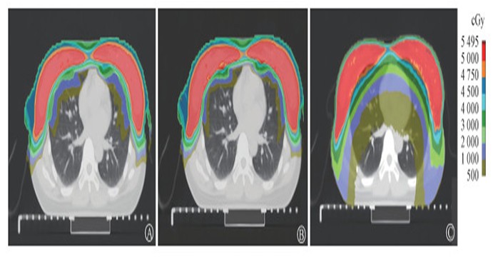 Dosimetric evaluation of intensity modulated proton therapy and photon volumetric modulated arc therapy for bilateral breast cancer