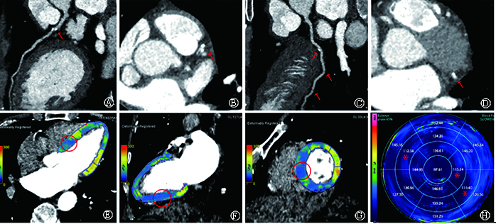 The feasibility study on the clinical application of CTP combined with deep learning image reconstruction algorithm in coronary artery disease