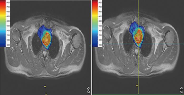 Effect of cavity structure delineation errors on target dosimetry in Unity MR-Linac radiotherapy
